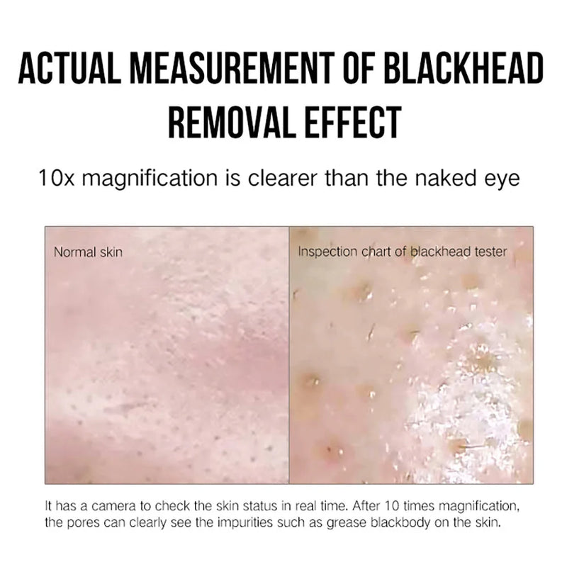 Facial Blackhead Remover for Deep Pore Care – eye, eyes, seal (Image 4)